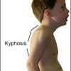 "Hunch-Back" - Called kyphosis
