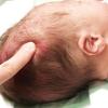 Large fontanelle (soft spot) on infant's head; abnormal skull shape
